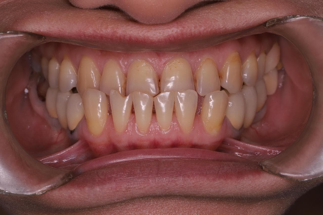 Əvvəl